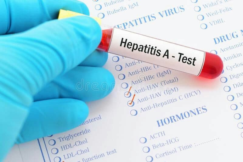 آزمایشات تشخیصی هپاتیت A