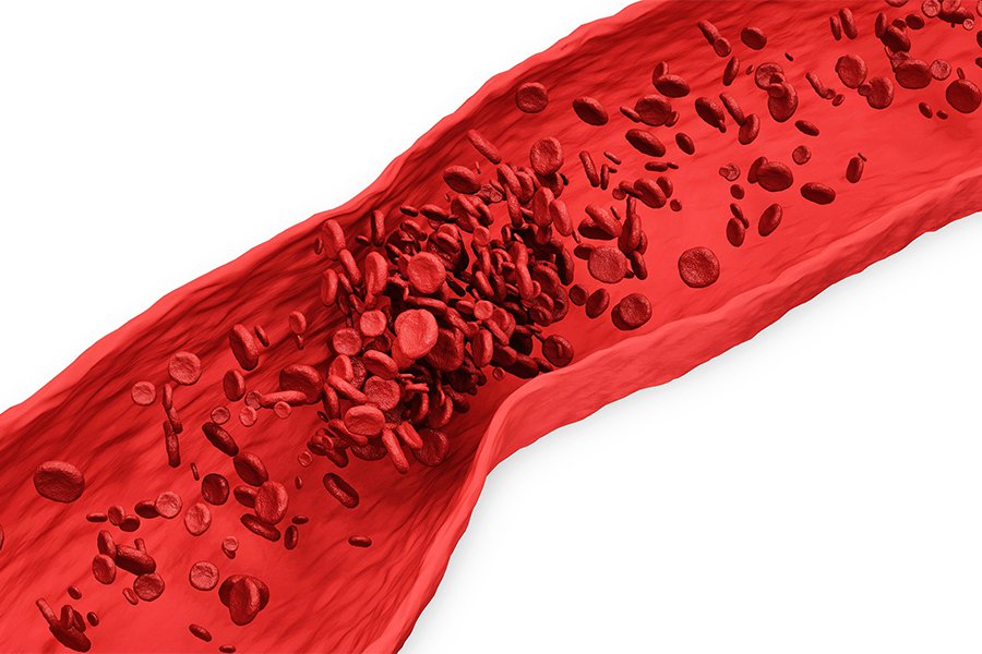 لخته‌های خون چگونه تشخیص داده می‌شوند؟