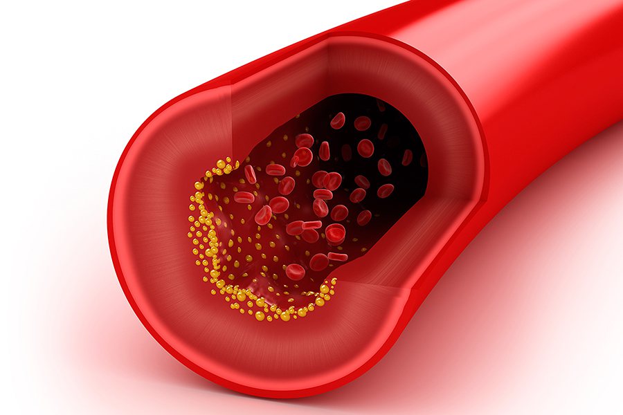 میزان کلسترول خون در سنین مختلف چقدر باید باشد؟
