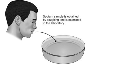آزمایش کشت خلط ریه (Sputum)